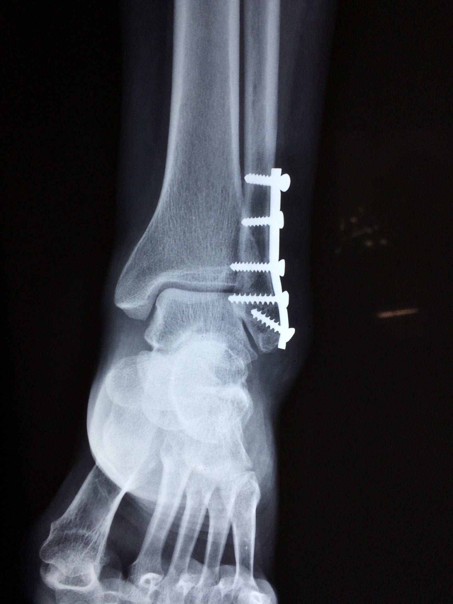 An image of a fractured ankle.