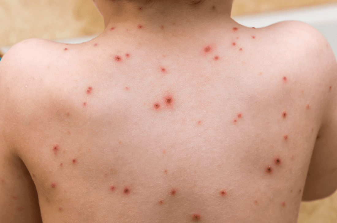 Can Red Light Therapy Treat Herpes Zoster (A.K.A. Shingles)? - Kineon
