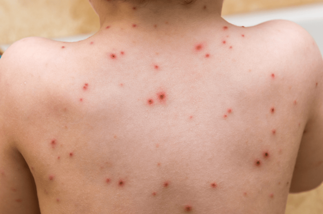 Can Red Light Therapy Treat Herpes Zoster (A.K.A. Shingles)? - Kineon
