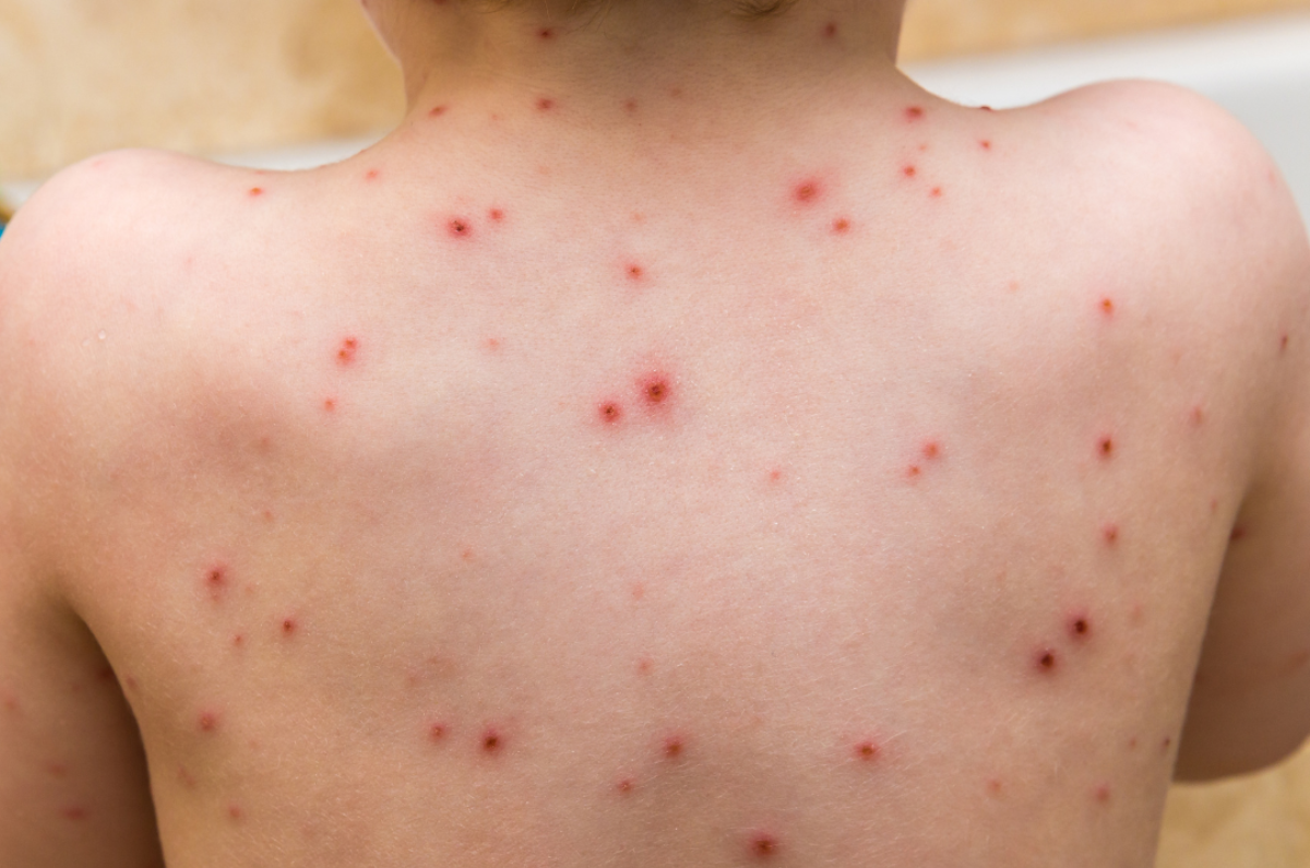 Can Red Light Therapy Treat Herpes Zoster (A.K.A. Shingles)?