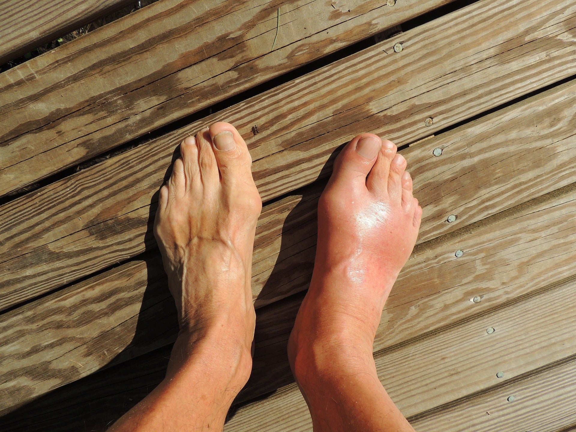An image of a swollen feet.